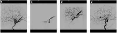 Management of carotid cavernous fistulas: A single center experience